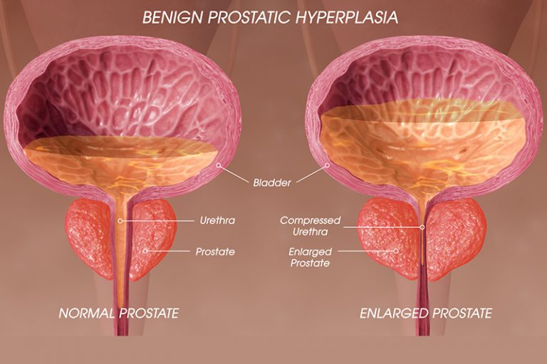 PROSTATE HEALTH – Benign Prostatic Hyperplasia (BPH)