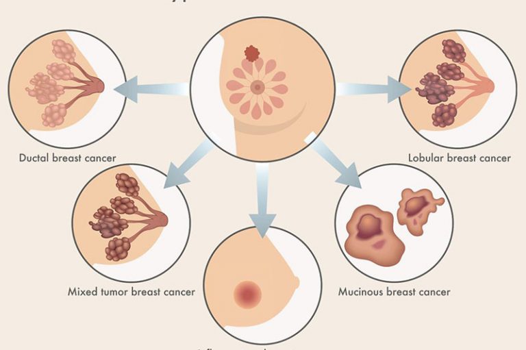 Breast Cancer Series 3 – Various Types and Treatments