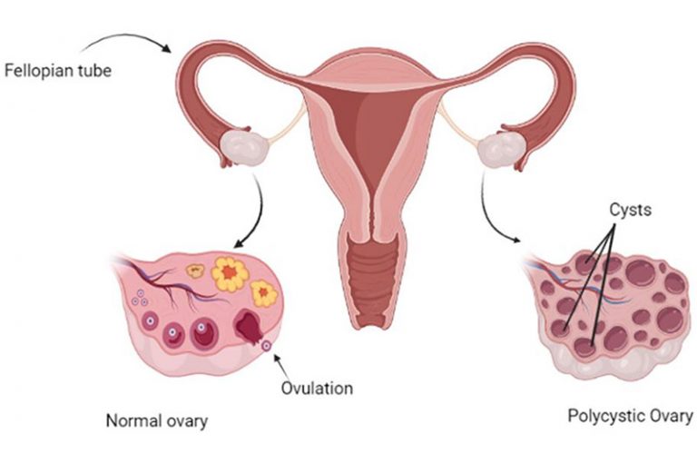 Polycystic Ovarian Syndrome