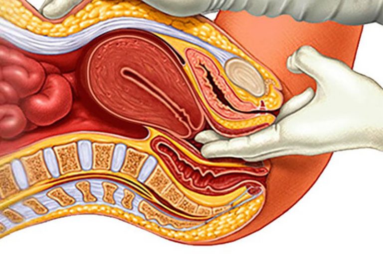 Polycystic Ovarian Syndrome – Series 3 – Treatment of PCOS