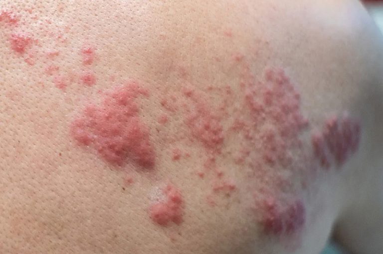 Shingles – Series 2 (Symptoms and diagnoses)